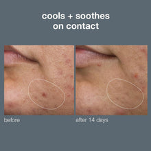 Load image into Gallery viewer, deep breakout invisible liquid patch - Dermalogica Malaysia